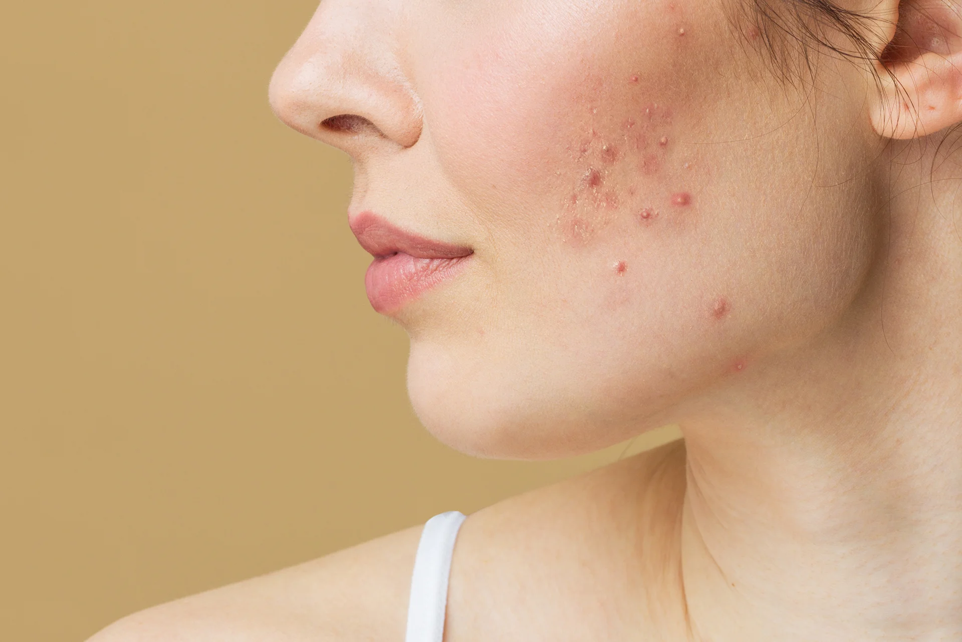 acne scars on the woman's face